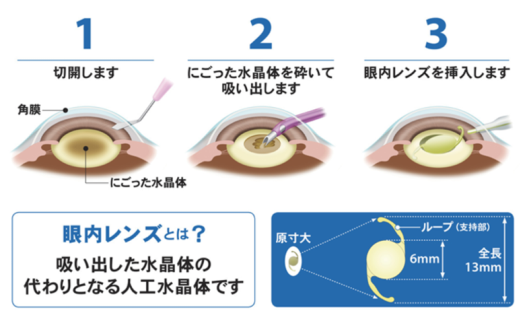 大阪市鶴見区の松山眼科医院は白内障の治療。手術を行っております。