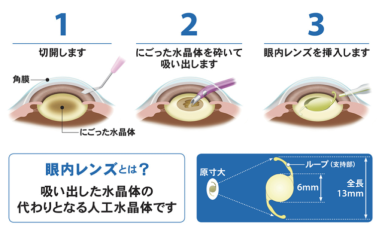 大阪市鶴見区の大阪鶴見まつやま眼科は白内障の治療。手術を行っております。