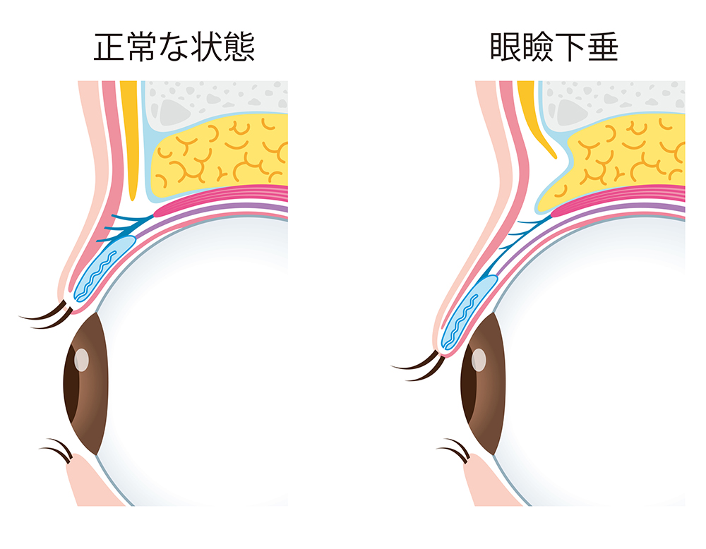 眼瞼下垂とは？症状・セルフチェック