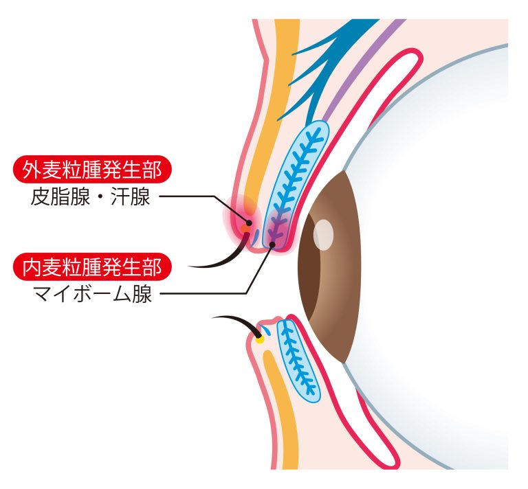 麦粒腫(ものもらいはストレス以外でも起こります