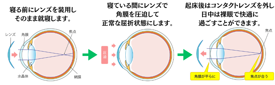 オルソケラトロジーのメカニズム