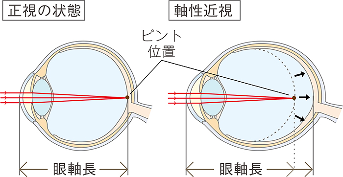 マイオピンで近視の進行を抑制することが大切な理由