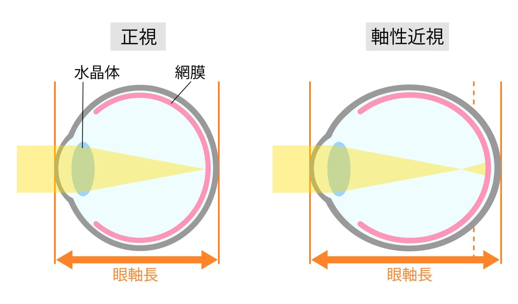 オルソケラトロジーのメリット
