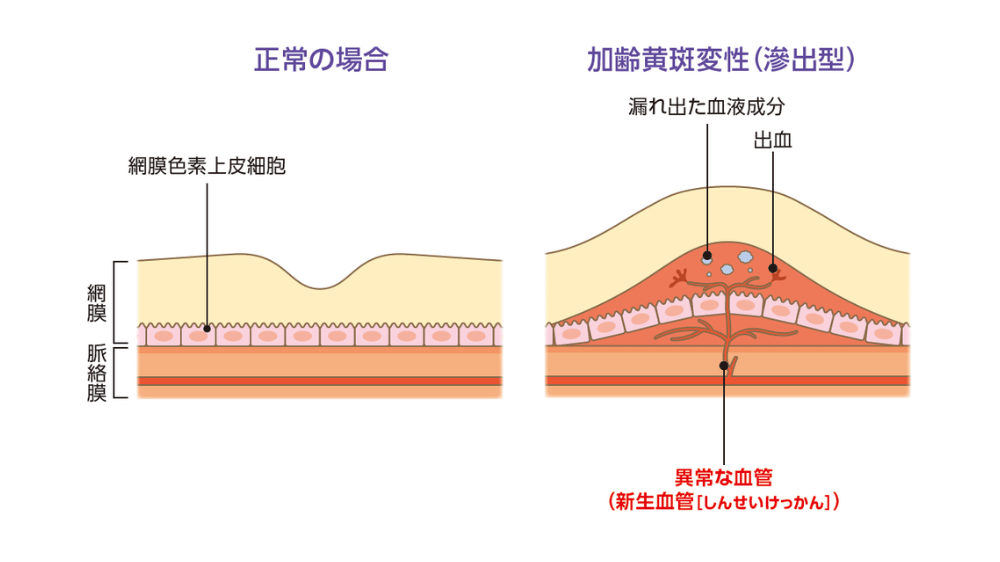 加齢黄斑変性症