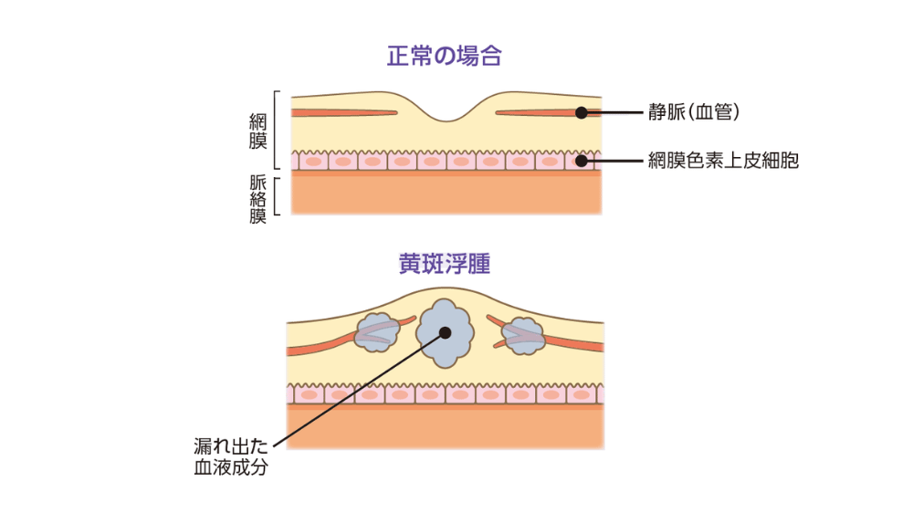 黄斑浮腫