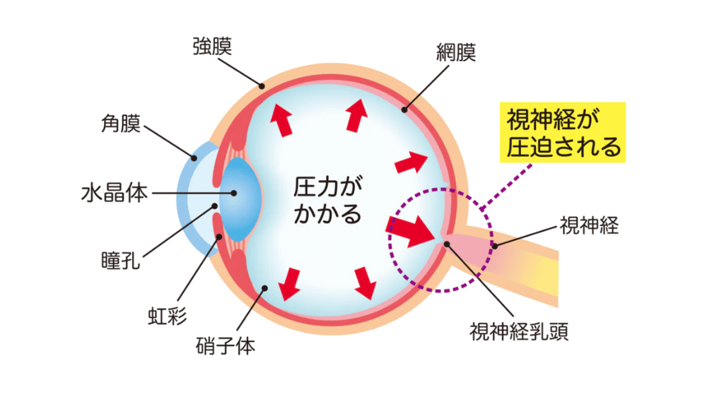 緑内障
