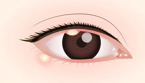 麦粒腫（ものもらい）・霰粒腫とは‐うつる病気？症状は？