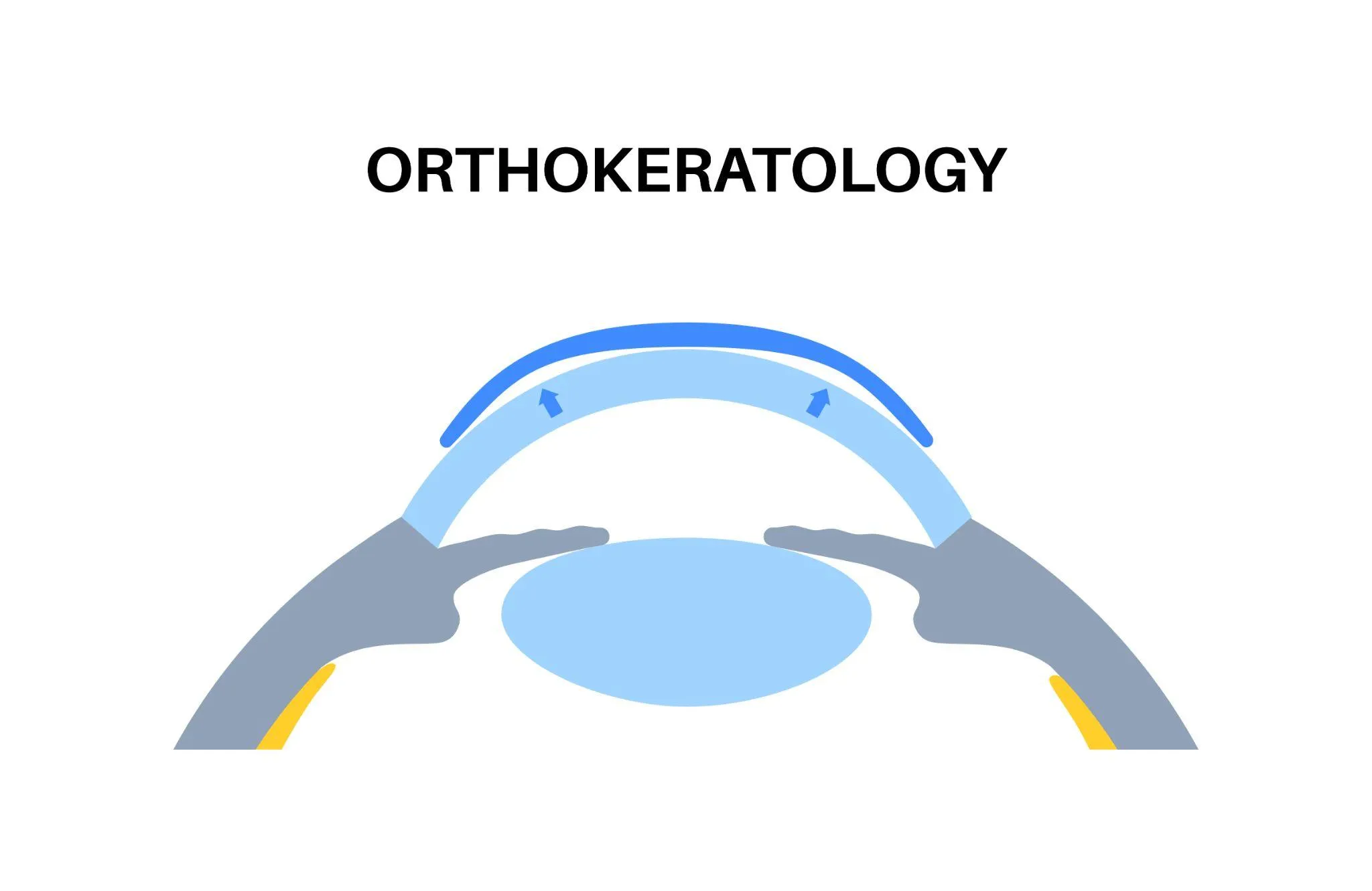 オルソケラトロジーとは？効果や副作用・向き不向きやしくみを紹介