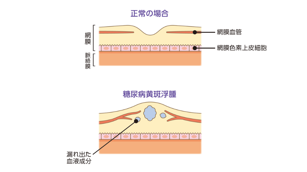 糖尿病黄斑浮腫