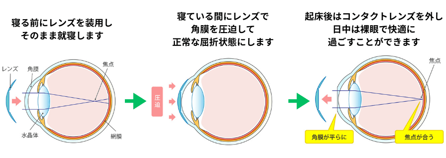 オルソケラトロジーで視力が回復する仕組み