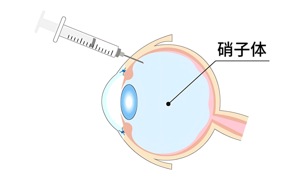 硝子体注射